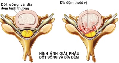 cach-don-gian-phong-thoat-vi-dia-dem.